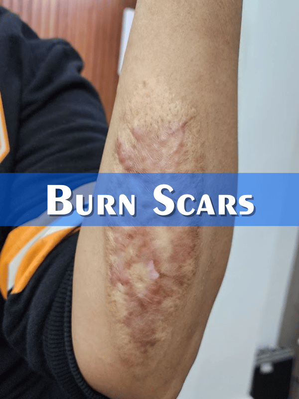 Burn Scars